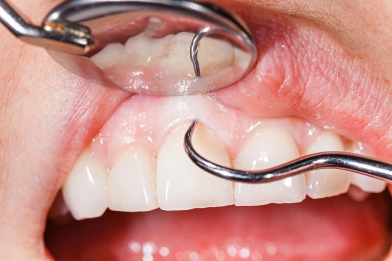 Gum Disease Warning Signs You Should Never Ignore